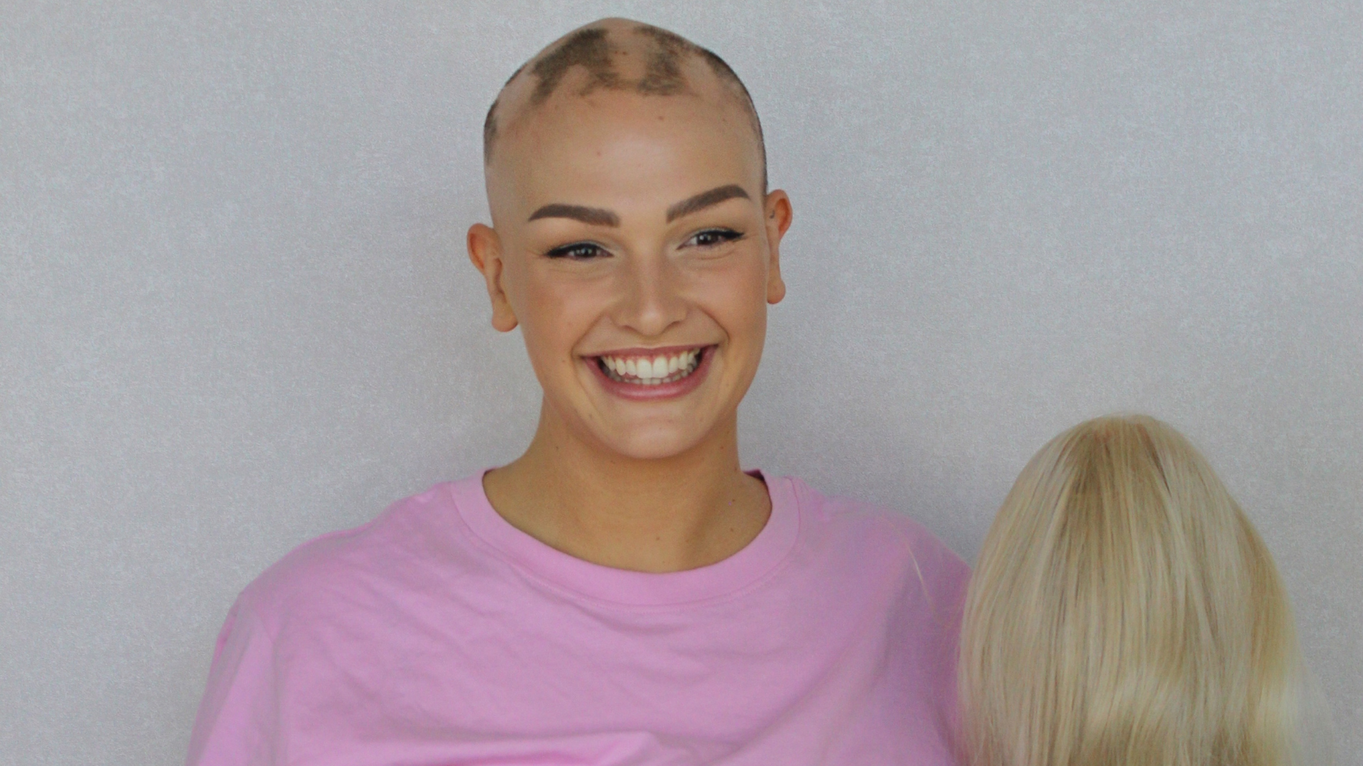 Navigating Hair Loss with Confidence: AAAF's Role in Supporting Those with Alopecia Areata