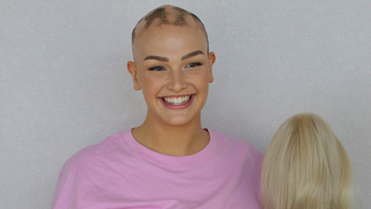 Navigating Hair Loss with Confidence: AAAF's Role in Supporting Those with Alopecia Areata