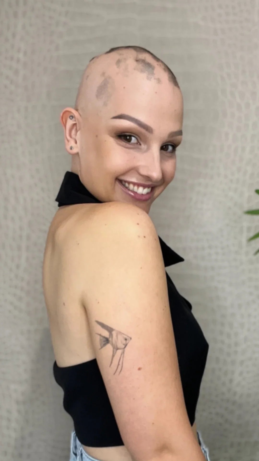 Navigating Hair Loss with Confidence: AAAF's Role in Supporting Those with Alopecia Areata